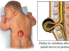 Spina bifida, ogni anno in Sardegna nascono 300 bambini spina-bifida-ogni-anno-in-sardegna-nascono-300-bambini