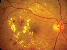 Retinopatia diabetica, risposte per malati retinopatia-diabetica-risposte-per-malati