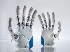 Mano bionica impiantata in una donna italiana